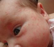 Аллергия на щеках у ребенка причины и лечение